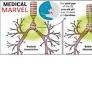 Rare Surgery Helps 22-Year-Old Breathe Easy